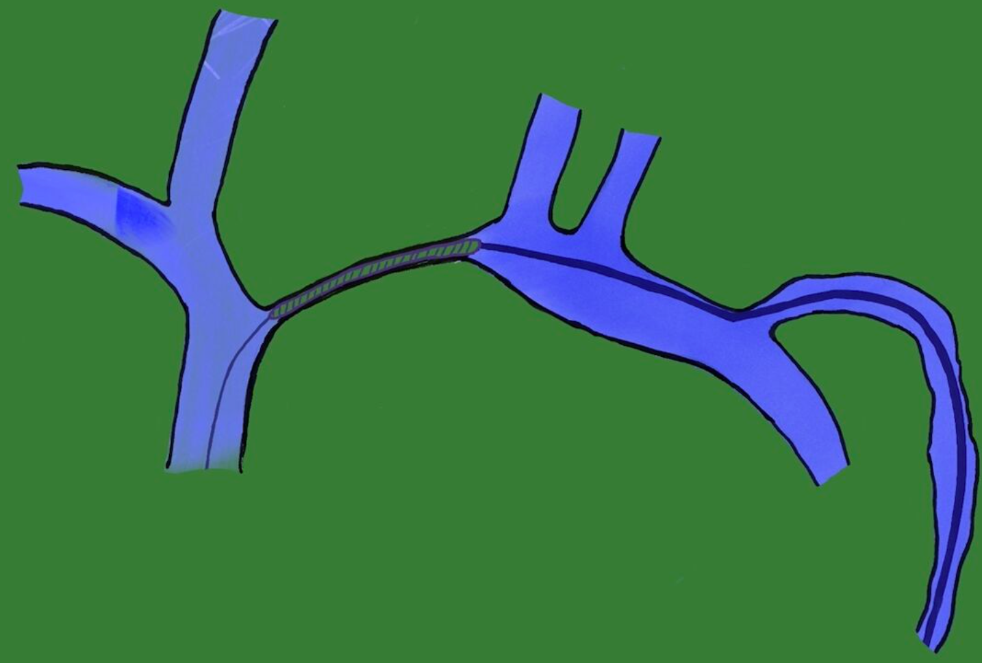 Endoguide — Navigating Endovascular Surgery